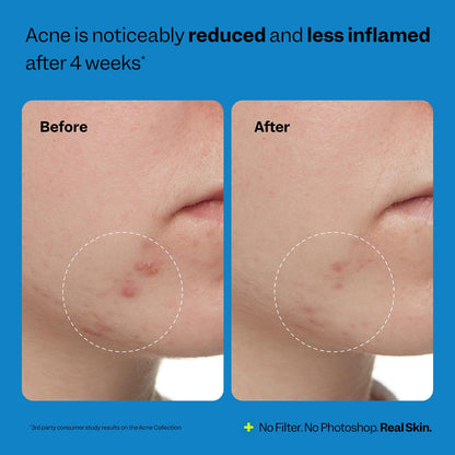 Peach Slices 3-Step Acne Starter Kit - Toner, Moisturiser, Cleanser