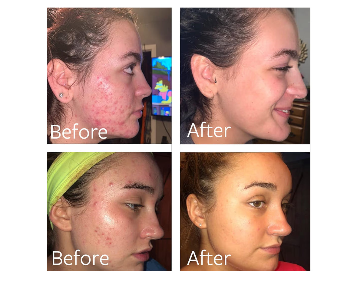 Dr Song 10% Benzoyl Peroxide & Hyaluronic Acid Acne Face & Body Wash