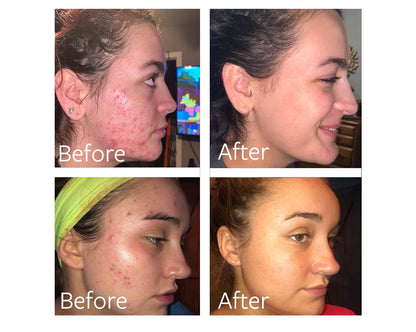 Dr Song 10% Benzoyl Peroxide & Hyaluronic Acid Acne Face & Body Wash