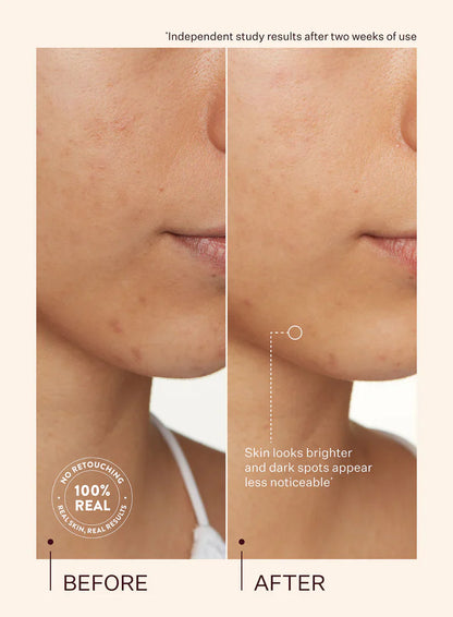 Peach & Lily Transparen-C Vitamin C ATIP Dark Spot Acne Treatment