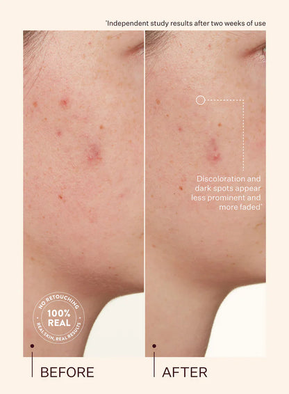 Peach & Lily Transparen-C Vitamin C ATIP Dark Spot Acne Treatment