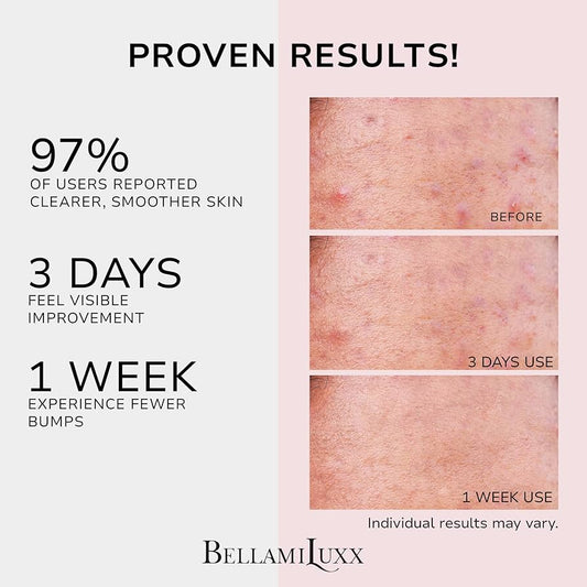 BellamiLuxx Butt & Body Acne Clearing Cream with Salicylic Acid