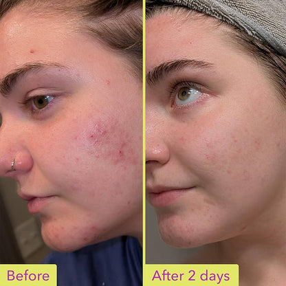 Good Molecules Azelaic Acid 10% Redness & Brightening Treatment